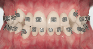 How_do_braces_work1