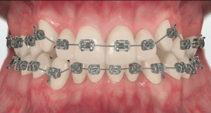 How_do_braces_work2