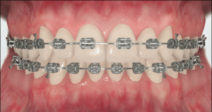 How_do_braces_work3