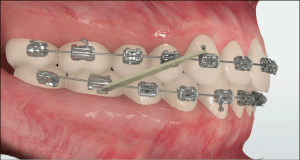 How_do_braces_work4